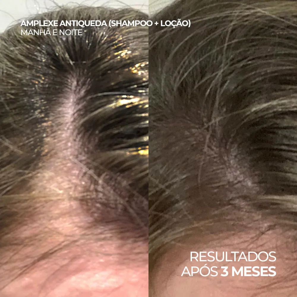 Kit Ada Tina Amplexe Shampoo 300ml e Loção Antiqueda