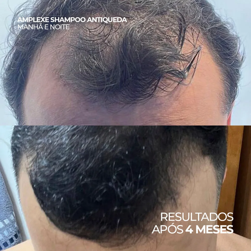 Kit Ada Tina Amplexe Shampoo e Loção Antiqueda